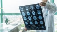 Foto de un medico mirando unas resonancias del cerebro