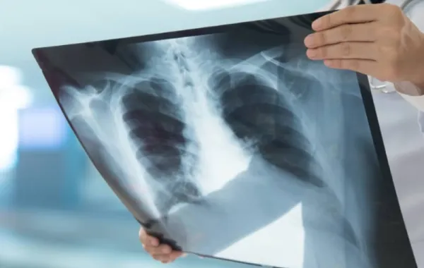 Cáncer de pulmón revisado por un médico en una radiografía