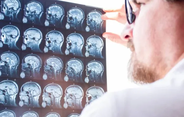 La esclerosis múltiple crece en España más de lo estimado