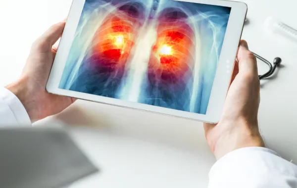 Foto de una radiografia de unos pulmones