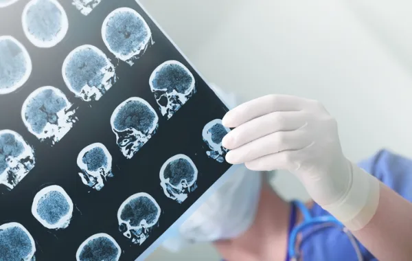 Foto de un medico que mira una ecografia del cerebro