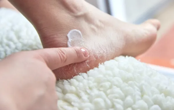 Foto de un pie de una persona que le está dando crema al talón seco