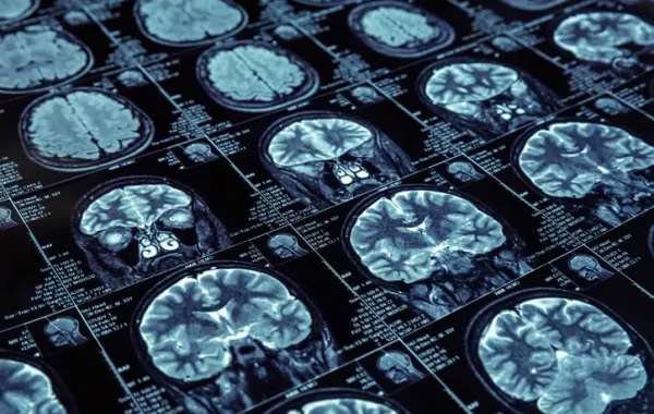 Varias radiografías del cerebro humano mostrando un posible deterioro