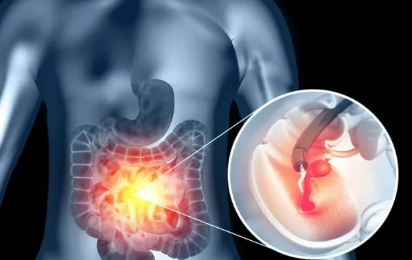 Ilustración de la localización de un cáncer colorrectal