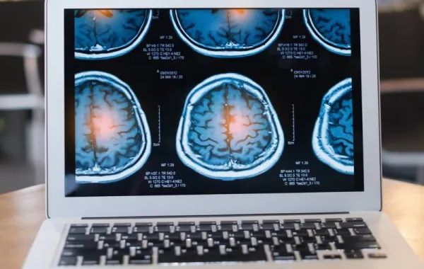 El ictus es la principal causa de discapacidad a nivel mundial y su incidencia continúa en aumento