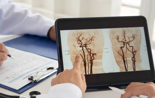 Equipo de investigadores identifican una proteína para prevenir el ictus