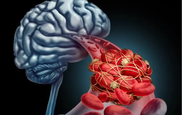 La trombosis ocurre cuando un coágulo sanguíneo bloquea el flujo de sangre y es una de las principales causas de muerte