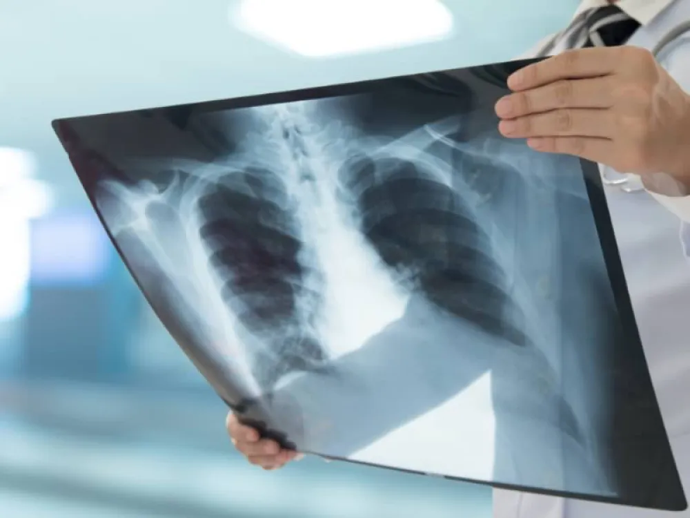 Cáncer de pulmón revisado por un médico en una radiografía