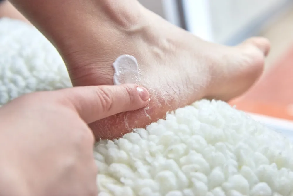 Foto de un pie de una persona que le está dando crema al talón seco
