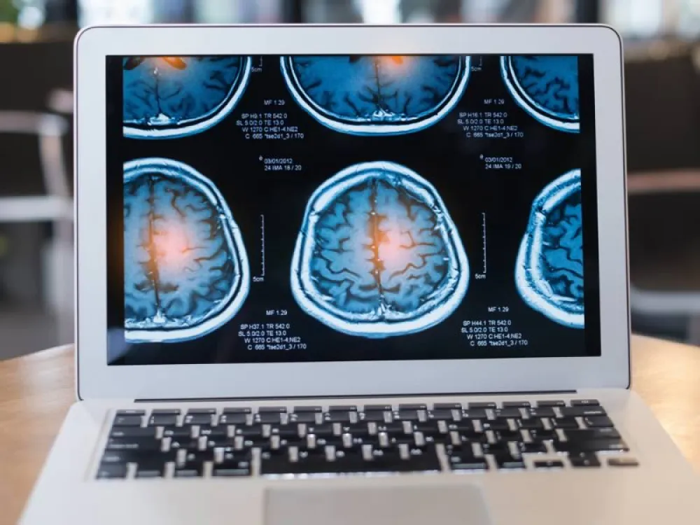 El ictus es la principal causa de discapacidad a nivel mundial y su incidencia continúa en aumento