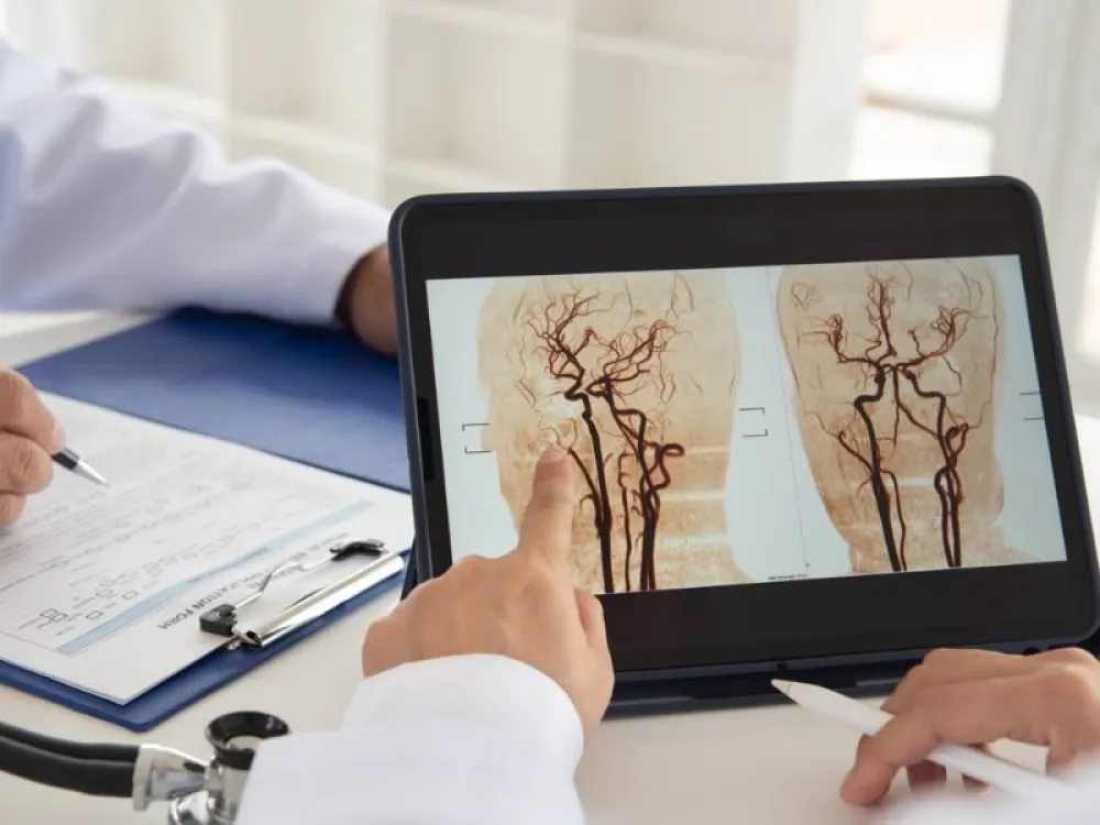 Equipo de investigadores identifican una proteína para prevenir el ictus